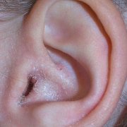 External Otitis