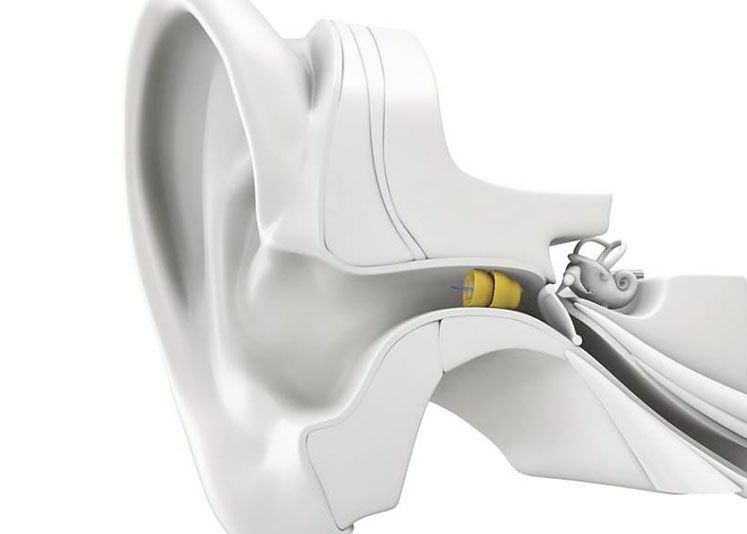 Wichita Ear Lyric Hearing Technology